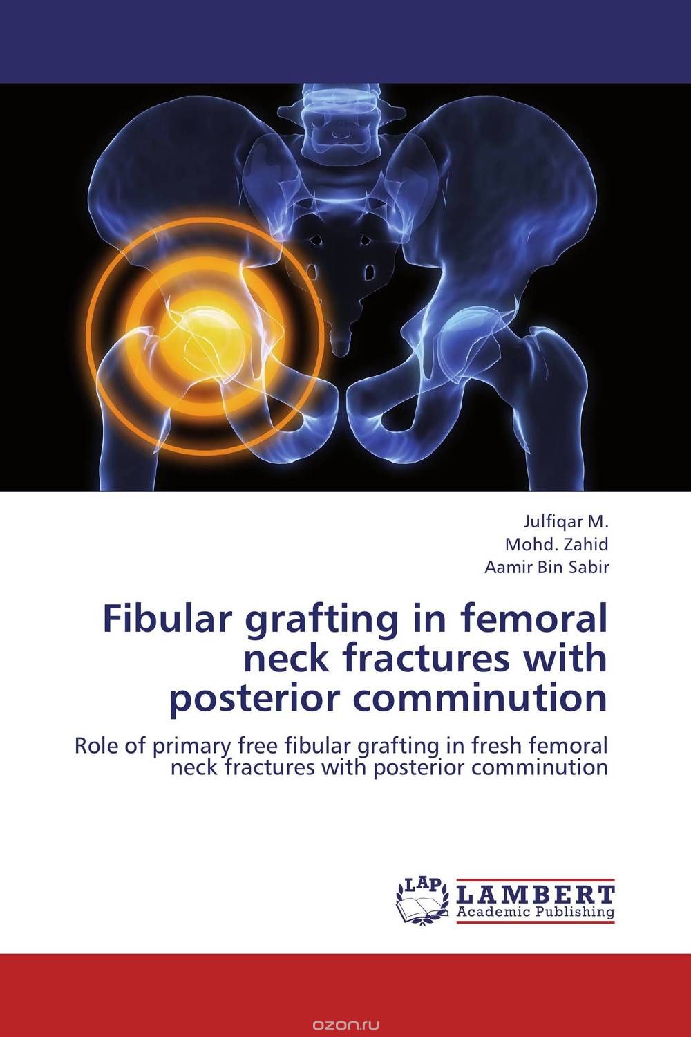 Скачать книгу "Fibular grafting in femoral neck fractures with posterior comminution"
