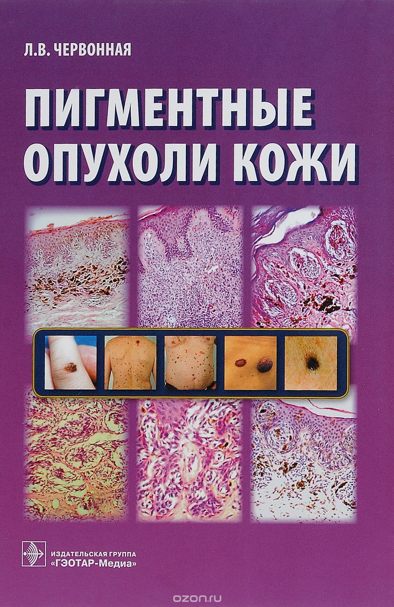 Пигментные опухоли кожи, Л. В. Червонная